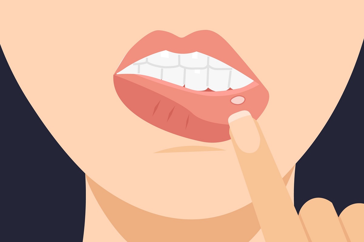 Tips Atasi Sariawan dengan Cara Alami Ilustrasi sariawan